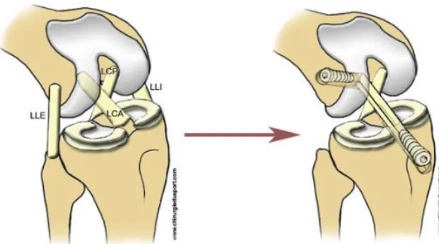 Figure 11.  Ligamentoplastie intra-articulaire (Chirurgie du sport) 