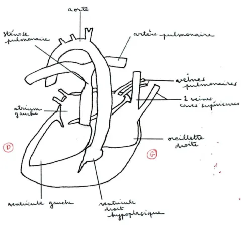 Figure 5 : Schéma représentant l’ensemble des malformations cardiaques de notre patient à la  naissance 
