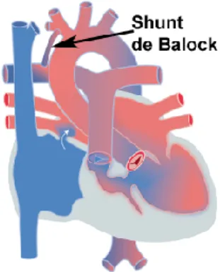 Figure 6 : Shunt de Blalock dans un cas d’atrésie tricuspide 