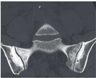 Figure 12 : Pincement de l’interligne sacro-iliaque et géodes sous chondrales dans le cadre  d’une arthrose bilatérale diffuse (d’après Berthelot (46))