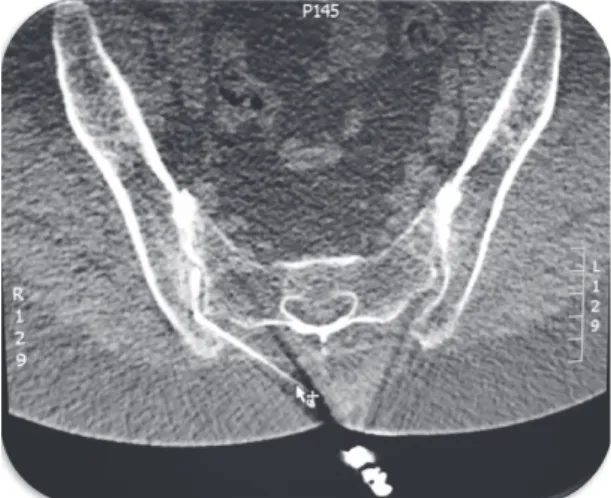 Figure 20: Infiltration sacro-iliaque droite sous guidage scanner. Arthrographie validant  l'injection intra-articulaire