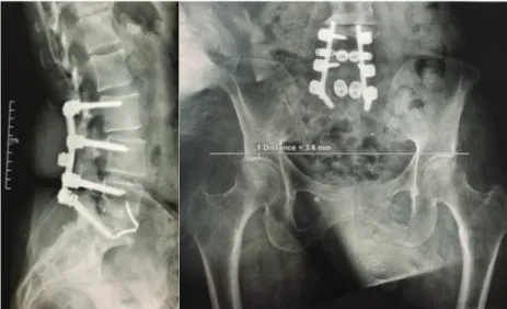 Figure 1 :  Deux exemples d’Arthrodèses Lombosacrées circonférentielles avec des douleurs  résiduelles plus d’un an après la chirurgie
