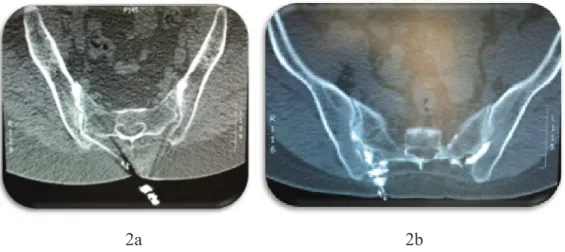 Figure 2 : Infiltrations réalisées par un radiologue, sous anesthésie locale et guidage TDM 2D  : La portion articulaire est au tiers antérieur de l’articulation SI sur les coupes axiales
