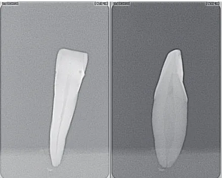 Fig 3  : Exemple de radiographie de &#34;face&#34; et de &#34;profil&#34; pour une dent ayant un Canal  Ovalaire