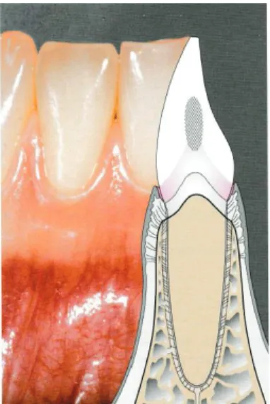 Fig. 2: Parodontite :  l’inflammation atteint les 