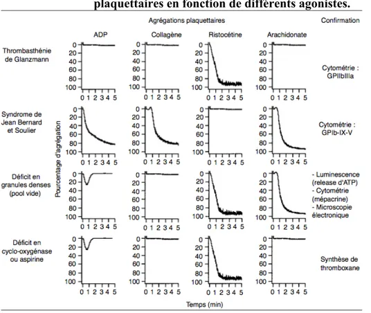 Figure 12 : Profils d'agrégation plaquettaire caractéristiques d'anomalies  plaquettaires en fonction de différents agonistes