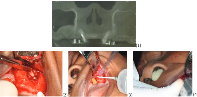 Figure 3 : Cas d’infection du matériau de greffe et infection sinusienne sus-jacente. (1)  Scanner à 3 mois postopératoire (2) décollement de la muqueuse et mis en évidence  de la fenêtre d’accès latérale (3) Injection de sérum physiologique par voie latér
