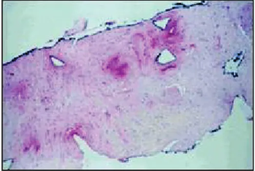 Figure 3 : Transformations tissulaire observée sur du tissus prostatique à 48h et à 3  mois après traitement par HIFU 