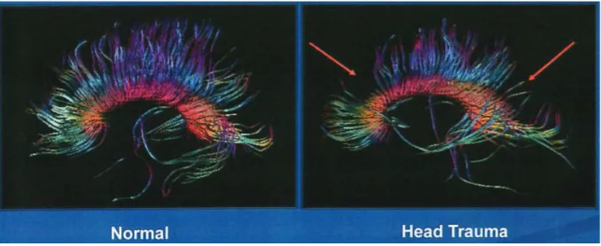 Figure 6 : Séquences IRM en DTI montrant les axones du corps calleux chez un patient sain à  gauche et avec dégénérescence axonale après traumatisme crânien sévère à droite (26)