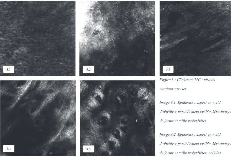 Figure 3 : Clichés en MC : lésions  carcinomateuses 