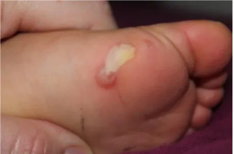 Figure 1: Blisters on the sole in a child 