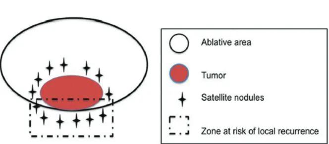 Figure 9 : Illustration d'une thermodestruction d'une tumeur avec micronodules satellites et du  risque de récidive locale associé (64)