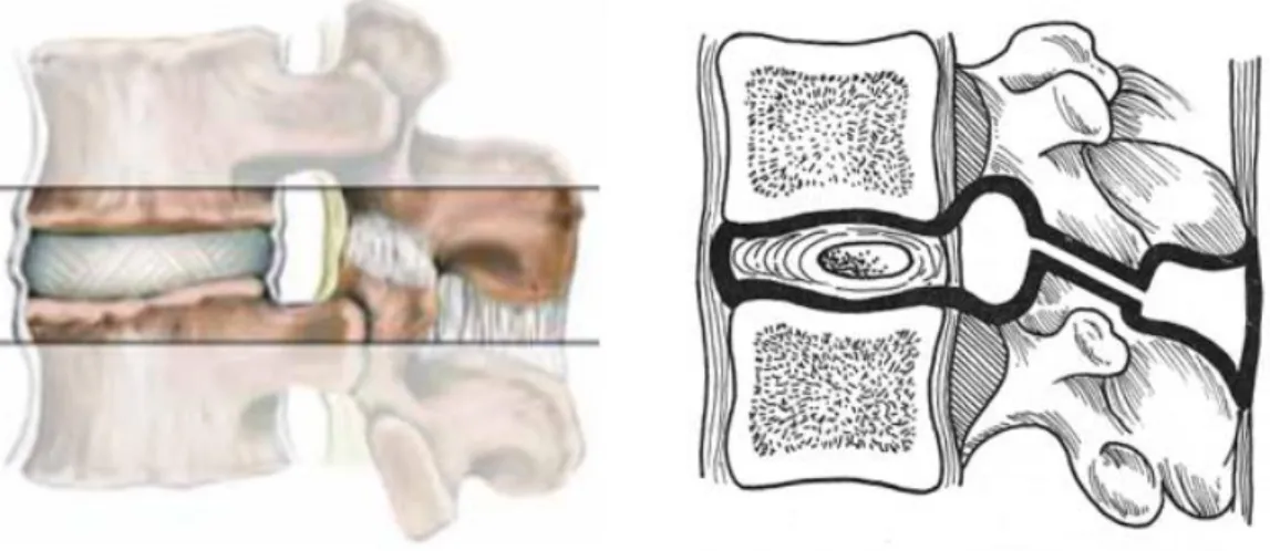 Figure 3. Vue latérale et schématisation du segment mobile vertébral 