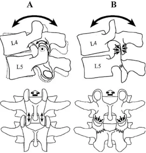 Figure 10. Facteur favorisant de spondylolyse ; l’arc neural  A. Normal, orientation sagittale des processus articulaires postérieurs 