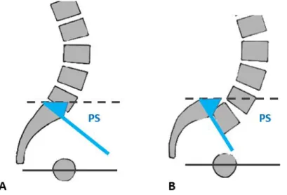 Figure 20. Mesure de la pente sacrée, angle formé entre le plateau supérieur de S1 et l’horizontale (A),  PS augmentée en cas d’antéversion pelvienne (B) 