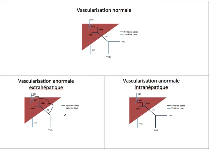 Figure 1 : Vascularisation hépatique normale et anormale 