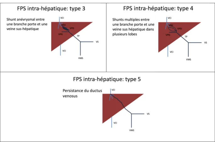 Figure 6 : Schéma des FPS intra-hépatiques selon la classification de Park (21) 