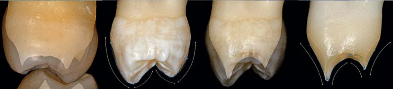 Figure 3 : Considérations structurelles (pour les dents cuspidées maxillaire) suivant la technique de  préparation basée sur la morphologie