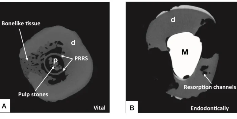 Figure 3 : Vues transversales microscanner permettant de visualiser la présence de la PRRS au niveau  d’une dent présentant une pulpe vitale avant extraction atteinte de résorption cervicale externe (A) 