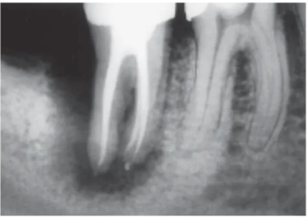 Figure 5 : Dent obturée endodontiquement 