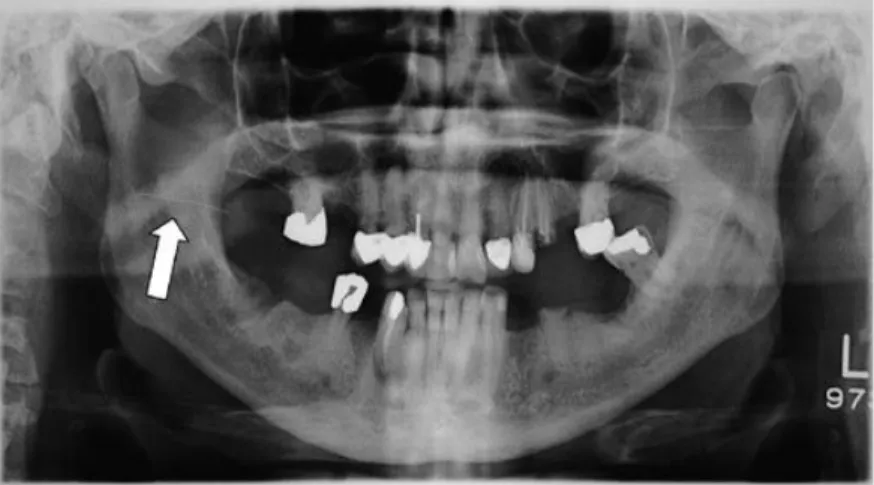 Figure 10 : Radiographie panoramique dentaire montrant la position de l’aiguille cassée 