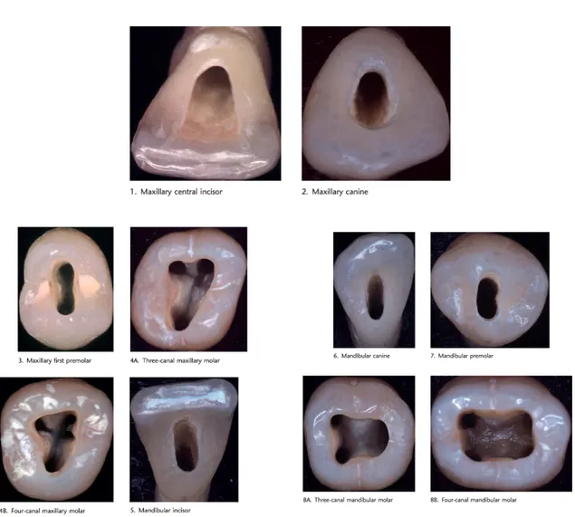 Figure 18 : Les cavités d’accès en fonction du type de dents traitées 