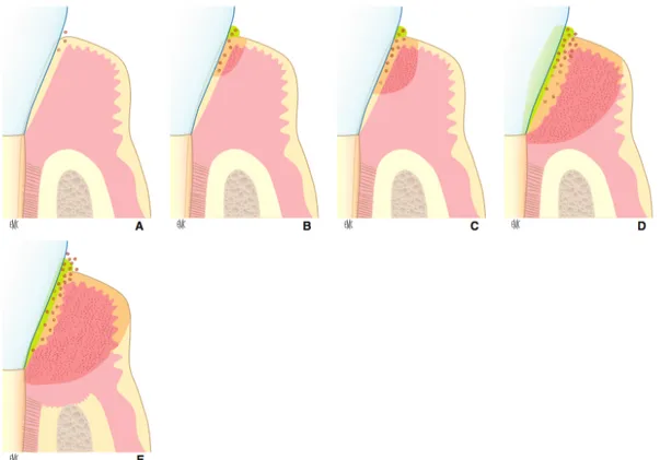 Figure 4 : Représentation schématique des 5 stades biologiques décrits par Page et Schroeder en 1976  (Pierrard et al