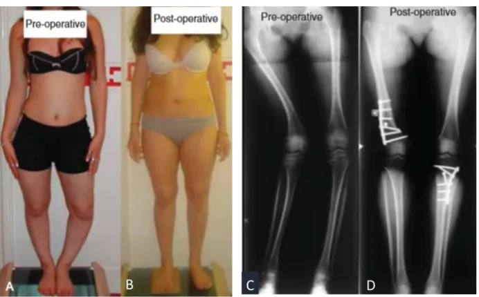 Figure 7 : Résultats de chirurgies d’ostéotomie chez une adolescente  