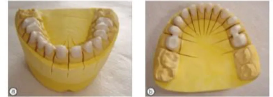 Figure 6: Prothèses conjointes réalisées pour un patient atteint d’AI  Source: Gulfem Ergun et al « Functional and Esthetic Rehabilitation of a Patient with 