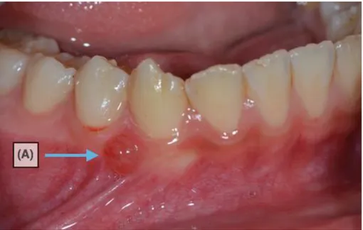 Figure 11 : Formule dentaire du jeune patient  (Source : Auteur) 