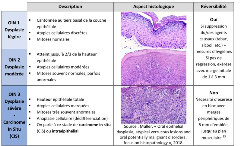 Tableau 4 : Classification OMS de la dysplasie épithéliale 