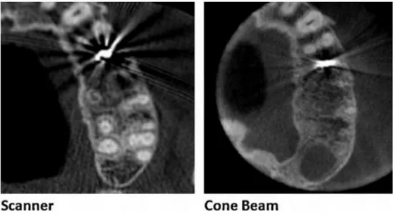 Figure 10 : Artéfacts métalliques du scanner supérieurs à ceux du cone beam chez un même patient 