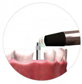 Figure 11 : Osstel IDx : appareil qui permet de vérifier l'ostéo-intégration de l'implant 