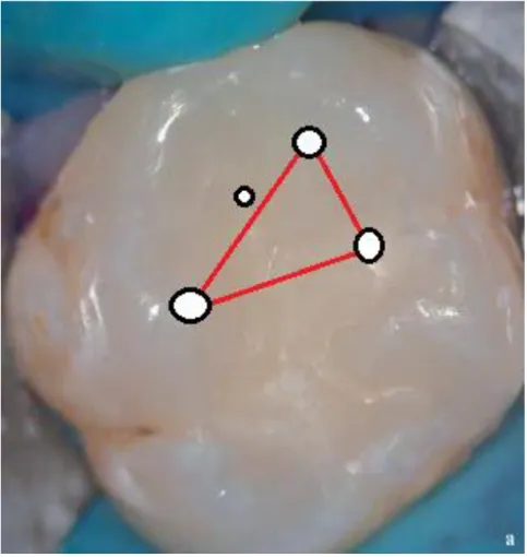 Figure 4 : Matérialisation du plafond pulpaire 