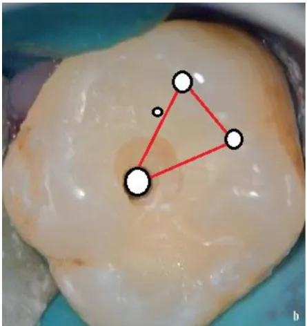 Figure 5 : Effraction pulpaire lors de l’approfondissement en direction pulpaire 