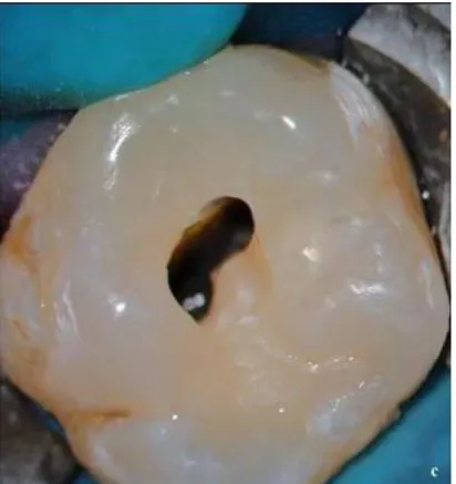 Figure 6 : Suppression du plafond pulpaire en cours 
