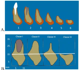 Figure 1 : Classification de Cawood et Howell (A)  et classification d’Atwood (B) 