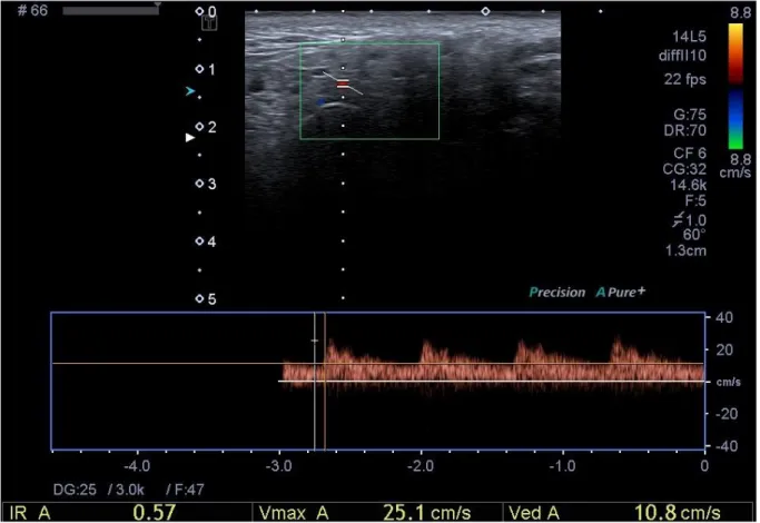 Figure 1: Doppler waveform analysis of arterial supply in parotid gland (Pathologic resistive  Index: 0,58)  