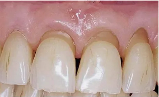 Figure 7 : Lésions vestibulaires lisses et concaves touchant préférentiellement la dentine cervicale,  caractéristiques d’un brossage horizontal traumatique 