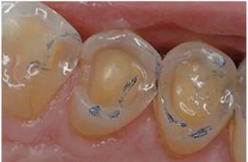 Figure 8 : lésions érosives en cuvettes, touchant préférentiellement la dentine 