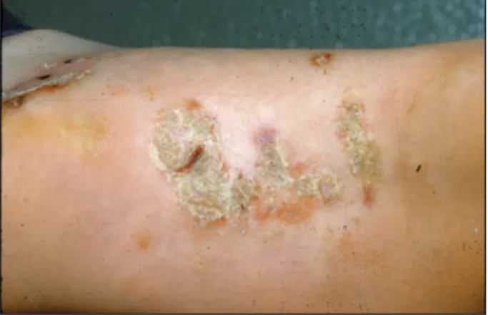 Figure 2. Eczéma dysidrosiforme.