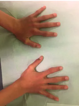 Figure 2: Symmetrical deformity of proximal interphalangeal joints of both hands.