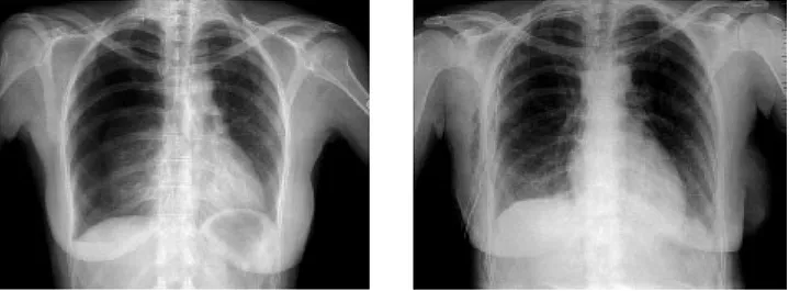 Fig. 2. Radiographie thoracique avant (A) et après (B) pleurodèse au talc chez une patiente de 31 ans présentant un 3ème épisode de pneumothorax spontané droit