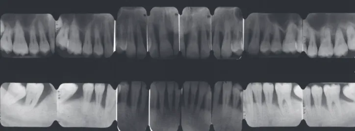 Figure 9 Bilan rétroalvéolaire d’un patient atteint d’une parodontite chronique globalement sévère  (33) 