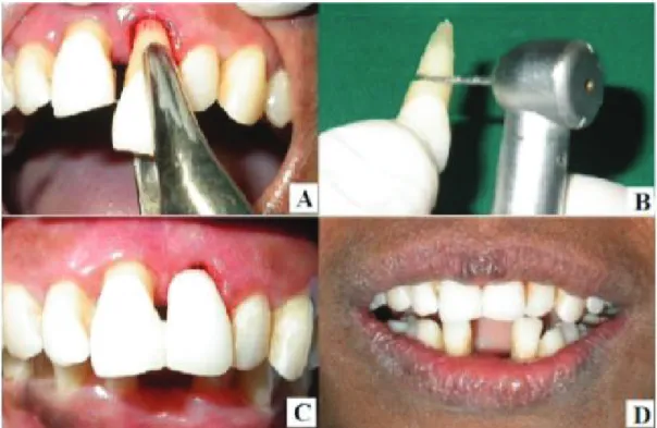 Figure 11 Contention fibrée avec inclusion d’une dent naturelle extraite (34)  A.  Avulsion de la 21 