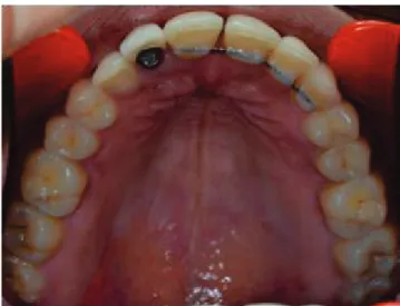 Figure 12 Contention métallique collée sur les dents antérieures maxillaires afin de servir d’attelle  parodontale (Dr SM Dridi) 