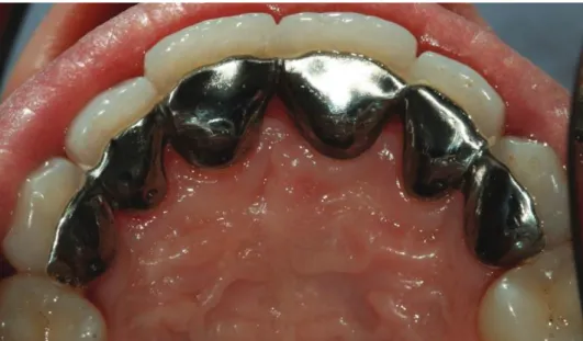 Figure 18 Contention coulée collée sur les faces palatines des dents maxillaires (Dr SM Dridi) 