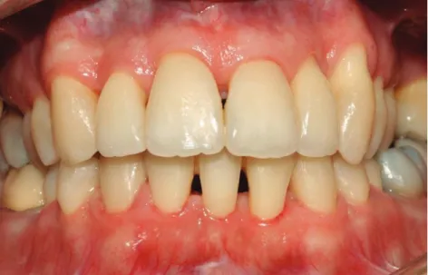 Figure 22 Arcades en occlusion avec les contentions collées à la mandibule et au maxillaire (Dr SM  Dridi) 