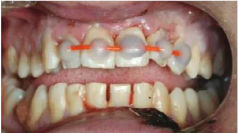 Figure 25 Fil de pêche collé sur les dents antérieures à l’aide d’une résine composite colorée (52) 