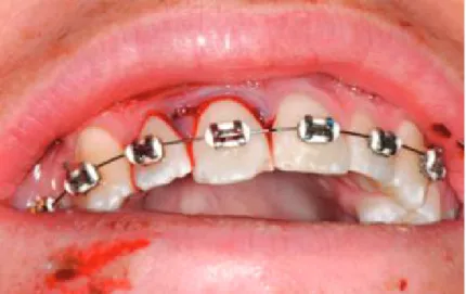 Figure 26 Contention avec fil orthodontique et brackets sur les dents maxillaires (52) 